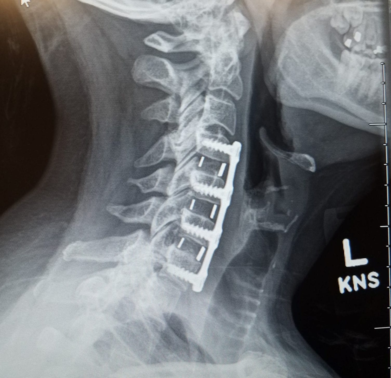 neck surgery following brutal chemo and radiation