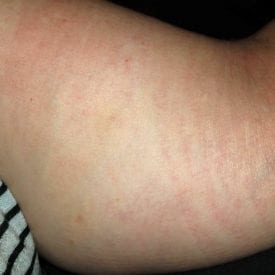 Lymphedema