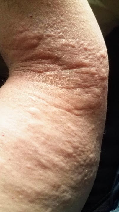 lymphedema woes